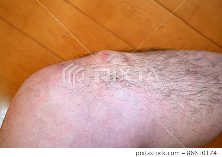 奧斯古德病 Osgood-Schlatter 病 膝蓋和腳的生長痛 奧斯古德病 Osgood-Schlatter 病 膝蓋和腳的生長痛 86610174
