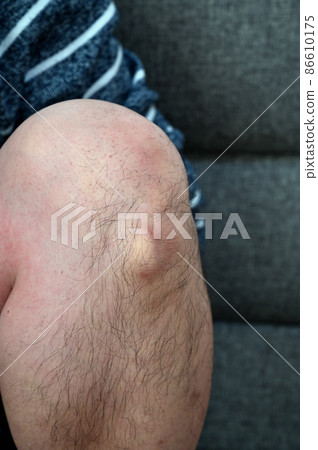 奧斯古德病 Osgood-Schlatter 病 膝蓋和腳的生長痛 86610175