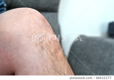奧斯古德病 Osgood-Schlatter 病 膝蓋和腳的生長痛 奧斯古德病 Osgood-Schlatter 病 膝蓋和腳的生長痛 86610177
