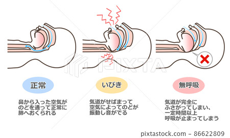 打鼾的插圖 86622809