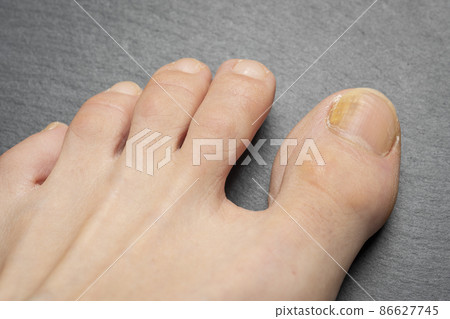Toenails with fungus problems on gray background Toenails with fungus problems on gray background 86627745