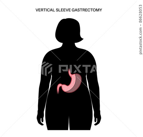 Laparoscopic sleeve gastrectomy 86628053