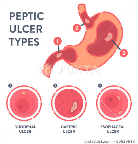 Types of peptic ulcer stomach disease infographics 86629619