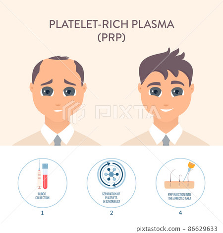 PRP hair loss treatment procedure medical poster 86629633