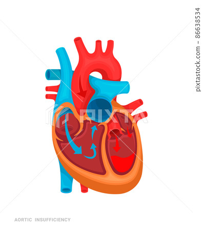 Heart defect. Aortic insufficiency. Illustration for medicine books, websites, apps. Heart disease with name. 86638534