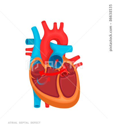Heart defect. Atrial septal defect. Illustration for medicine books, websites, apps. Heart disease with name. 86638535