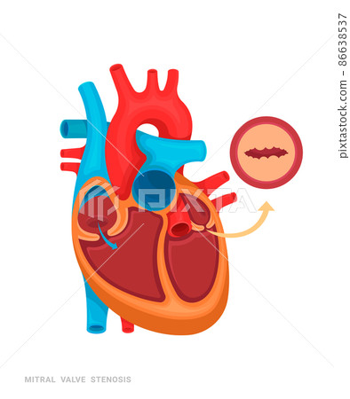 Heart defect. Mitral velve stenosis. Illustration for medicine books, websites, apps. Heart disease with name. Heart defect. Mitral velve stenosis. Illustration for medicine books, websites, apps. Heart disease with name. 86638537