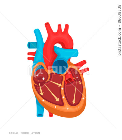 Heart defect. Atrial fibrillation. Illustration for medicine books, websites, apps. Heart disease with name. Heart defect. Atrial fibrillation. Illustration for medicine books, websites, apps. Heart disease with name. 86638538