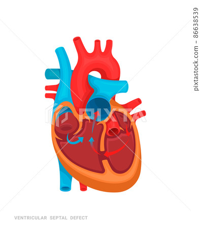 Heart defect. Ventricular septal defect. Illustration for medicine books, websites, apps. Heart disease with name. 86638539
