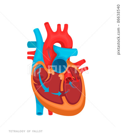 Heart defect. Tetralogy of fallot. Illustration for medicine books, websites, apps. Heart disease with name. 86638540