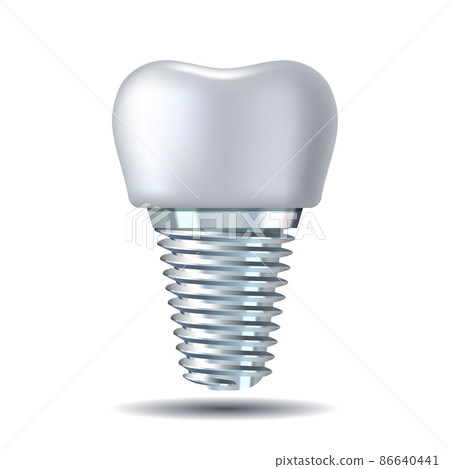 Vector 3d realistic white Tooth Implant. Denture icon closeup isolated on white Vector 3d realistic white Tooth Implant. Denture icon closeup isolated on white 86640441