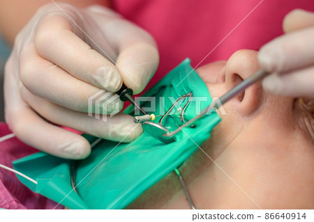 A patient with a cheek retractor with a green cofferdam in a dental clinic, a dentist in latex gloves examines her teeth with a boron and a mirror. 86640914