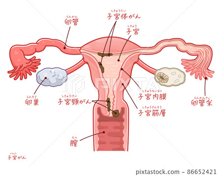 子宮內膜癌和宮頸癌圖解(附文字) 子宮內膜癌和宮頸癌圖解(附文字) 86652421