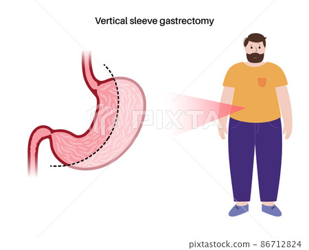 Laparoscopic sleeve gastrectomy 86712824
