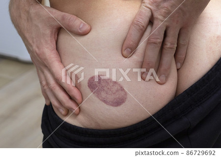 man buttock with hematomas marks after taking cupping therapy. man buttock with hematomas marks after taking cupping therapy. 86729692