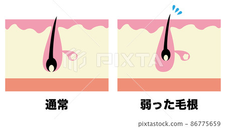 Pore (normal / weakened hair root) 86775659
