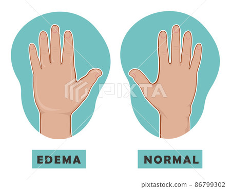 Swollen hand and normal hand. Edema and lymphedema. Vector illustration of the disease before-after. 86799302