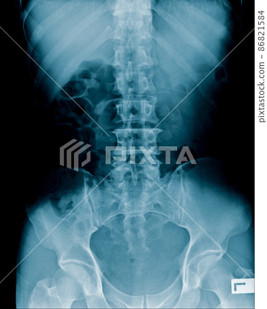 x-ray image of human abdomen, picture of human spine x-ray image of human abdomen, picture of human spine 86821584