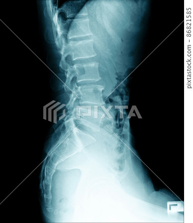 x-ray image of human abdomen, picture of human spine 86821585
