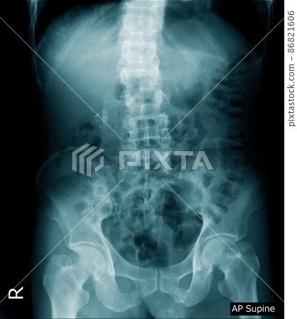x-ray image of human abdomen, picture of human spine and pelvic bone show degenerative change of spine 86821606
