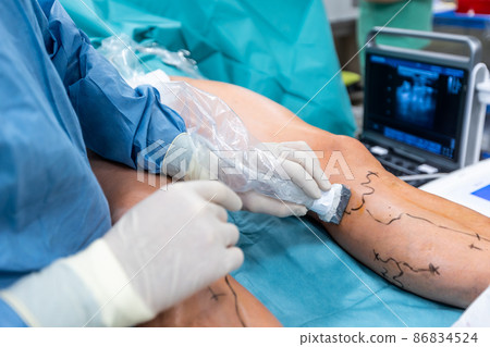 Process of varicose vein surgery in hospital, operating room, vein sealing, venous vascular surgery concept 86834524