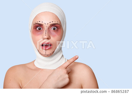 Beautiful woman before plastic surgery with bandaged face. Girl looks shocked, points fore finger aside, with opened mouth and surgical lines afraids going to operating room. Cosmetics surgery concept Beautiful woman before plastic surgery with bandaged face. Girl looks shocked, points fore finger aside, with opened mouth and surgical lines afraids going to operating room. Cosmetics surgery concept 86865287