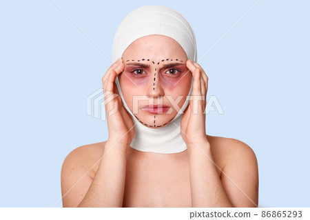 Photo of tired girl on blue background. Woman with bruise around eyes and bandages on head has headache. Female keeps hand on tremples and feels bad after cosmetic surgary. Plastic surgary concept. 86865293