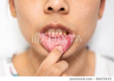 Asian woman have Aphthous ulcer or Canker sore on mouth at lip 86870919