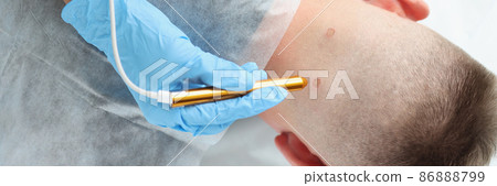 Doctor dermatologist laser cauterization of wart on man neck Doctor dermatologist laser cauterization of wart on man neck 86888799