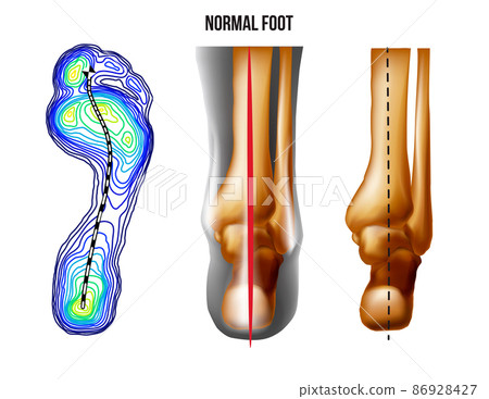 Foot weight distribution. Normal arch foot bottom and back view. No deformation. 86928427