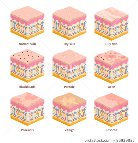 3d human skin types cross section layers. Dry, oily and normal epidermis. Skin problems, acne, blackheads, psoriasis and vitiligo vector set 3d human skin types cross section layers. Dry, oily and normal epidermis. Skin problems, acne, blackheads, psoriasis and vitiligo vector set 86929885