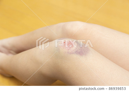 Blue bruises around the scratches 86939853