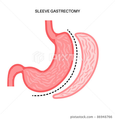 Laparoscopic sleeve gastrectomy Laparoscopic sleeve gastrectomy 86948766