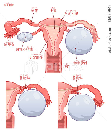 Illustration of uterus with ovarian cyst and pedicle torsion (with text) 86950945