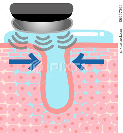 使用面部設備護理皮膚時皮膚細胞（毛孔）的橫截面視圖 86967593