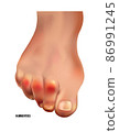 Realistic hammer toes of human leg with red pain points frontal view. 86991245