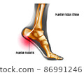 Plantar fasciitis inflammation and ruptures strain. Foot pain, realistic anatomy illustration 86991246