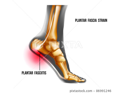 Plantar fasciitis inflammation and ruptures strain. Foot pain, realistic anatomy illustration 86991246