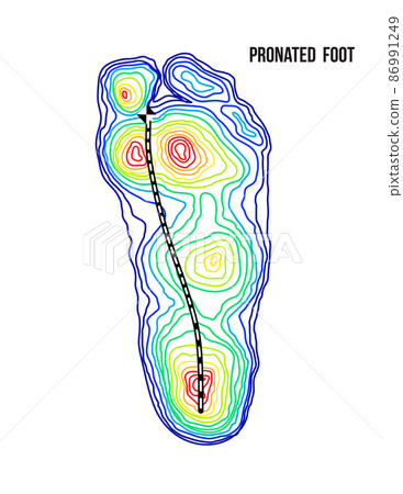 Pronated foot, arch deformation, bottom view. Foot weight distribution. 86991249