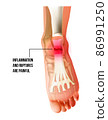 Foot pain, plantar fasciitis inflammation and ruptures strain bottom view. Realistic anatomy illustration 86991250