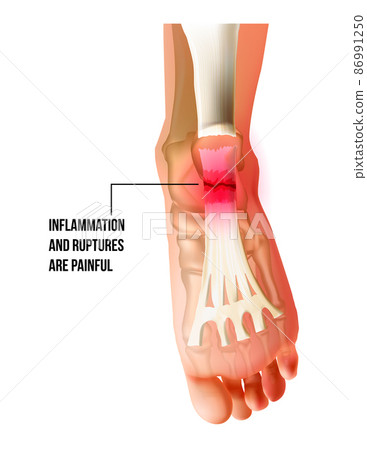 Foot pain, plantar fasciitis inflammation and ruptures strain bottom view. Realistic anatomy illustration 86991250