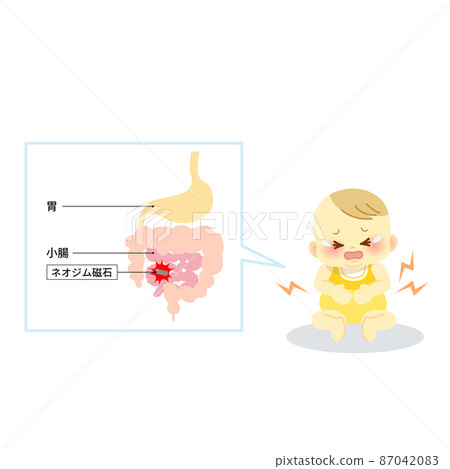 插圖解釋了玩具(磁鐵拼圖)損壞並且內置釹磁鐵刺穿腸壁的場景。 插圖解釋了玩具(磁鐵拼圖)損壞並且內置釹磁鐵刺穿腸壁的場景。 87042083