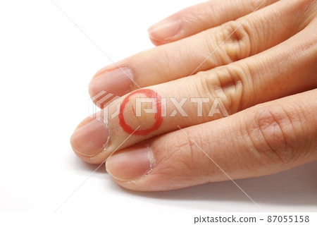 Rhagades male finger Rhagades male finger 87055158