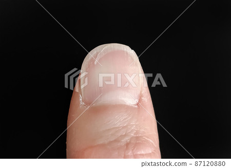 Missing and damaged nails 87120880