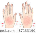 Chilblains and rough back of the hand 87133190