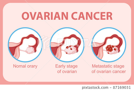 Ovarian cancer infographic infographic 87169031