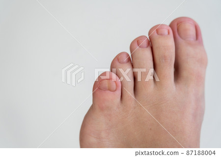 Female feet with a big double little toe on white background Female feet with a big double little toe on white background 87188004