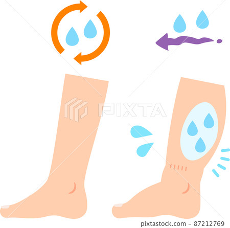 Swollen and normal feet 87212769
