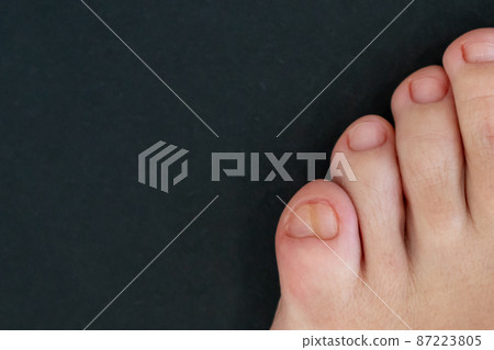 Female feet with big double little toe on black background Female feet with big double little toe on black background 87223805