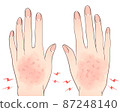Hands suffering from rhagades and chilblains 87248140